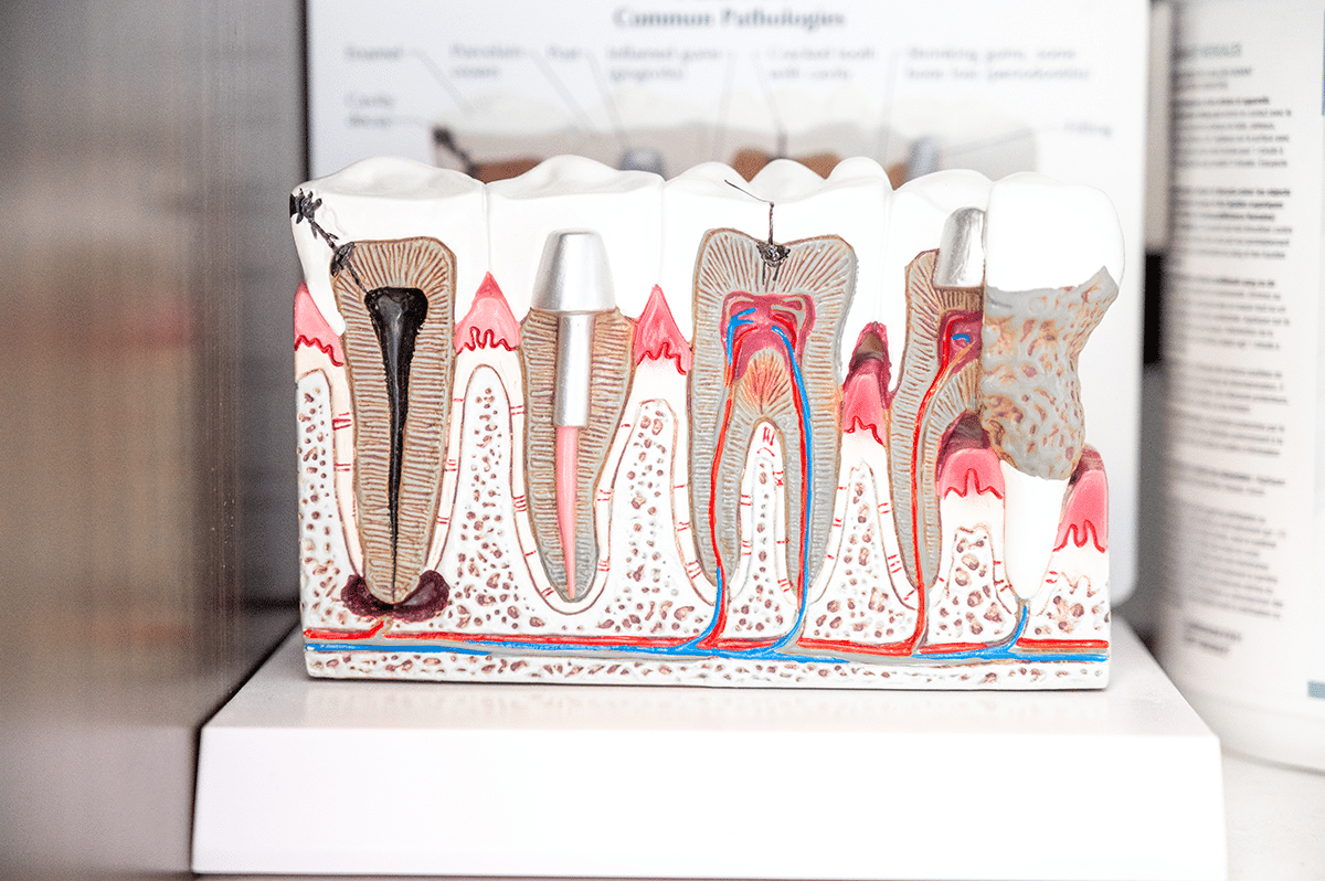 A dental model displaying various tooth structures, including roots, nerves, and surrounding gum tissue, illustrating dental anatomy and potential pathologies.